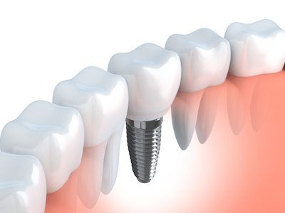 example of a dental implant