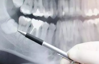 dentist explaining an x-ray of wisdom teeth